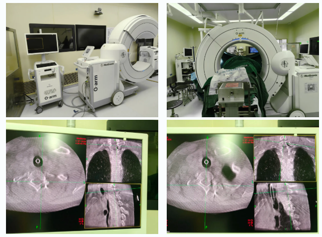 突破「手术禁区」—— 湖州市中心医院「三合一」精准微创治疗高位胸椎间盘突出