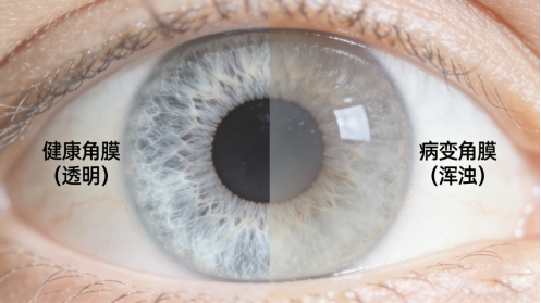 角膜移植手术要多久？ 术后几天能回家？一文解答
