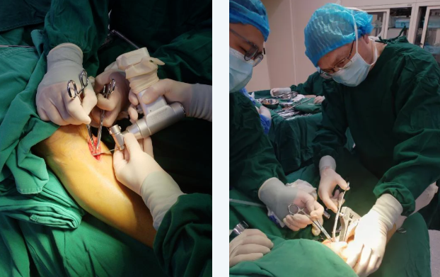 黔江中心医院骨关节科率先开展 APTT-HTO 技术 引领膝关节保膝治疗新时代!