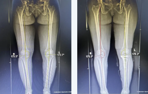 黔江中心医院骨关节科率先开展 APTT-HTO 技术 引领膝关节保膝治疗新时代!