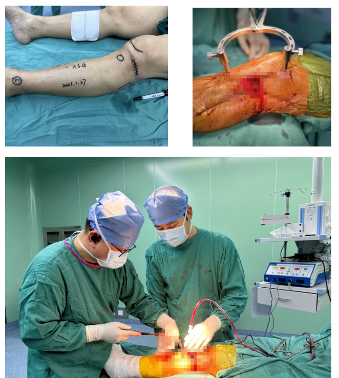 精雕细琢 | 创伤骨科微创技术让胫骨平台骨折手术「化繁为简」