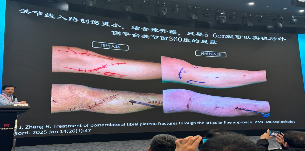 精雕细琢 | 创伤骨科微创技术让胫骨平台骨折手术「化繁为简」