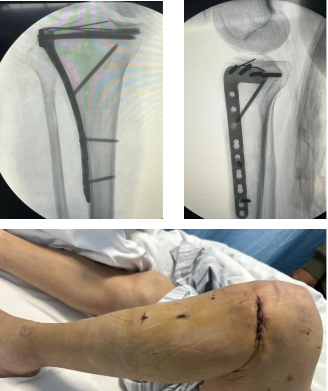 精雕细琢 | 创伤骨科微创技术让胫骨平台骨折手术「化繁为简」