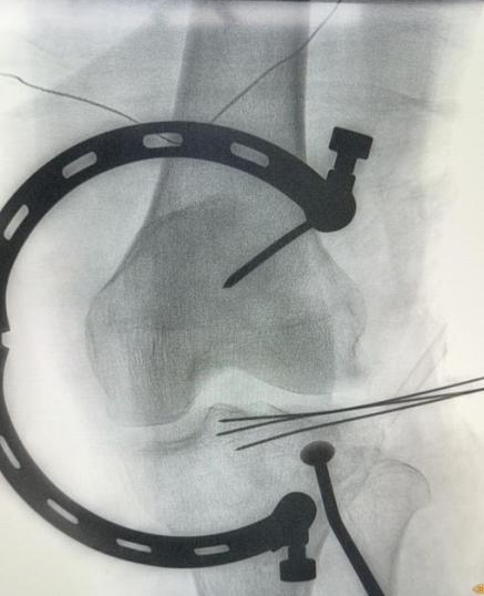 精雕细琢 | 创伤骨科微创技术让胫骨平台骨折手术「化繁为简」