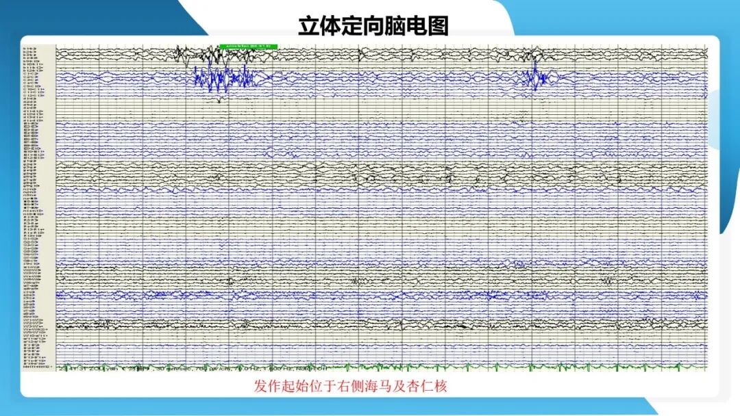 《「痫停」信步》癫痫治疗病例荟萃第五十三期：立体定向脑电图引导射频热凝毁损（SEEG-RFTC）治疗难治性癫痫 1 例