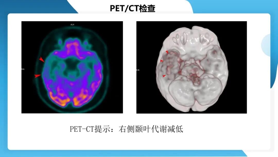 《「痫停」信步》癫痫治疗病例荟萃第五十三期：立体定向脑电图引导射频热凝毁损（SEEG-RFTC）治疗难治性癫痫 1 例