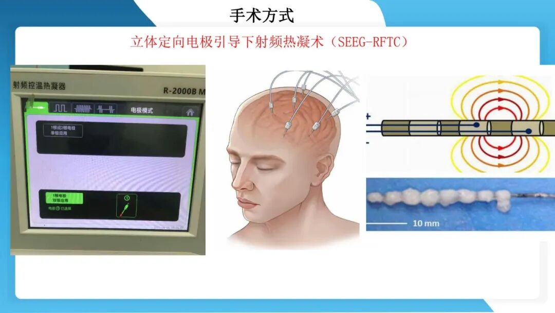 《「痫停」信步》癫痫治疗病例荟萃第五十三期：立体定向脑电图引导射频热凝毁损（SEEG-RFTC）治疗难治性癫痫 1 例