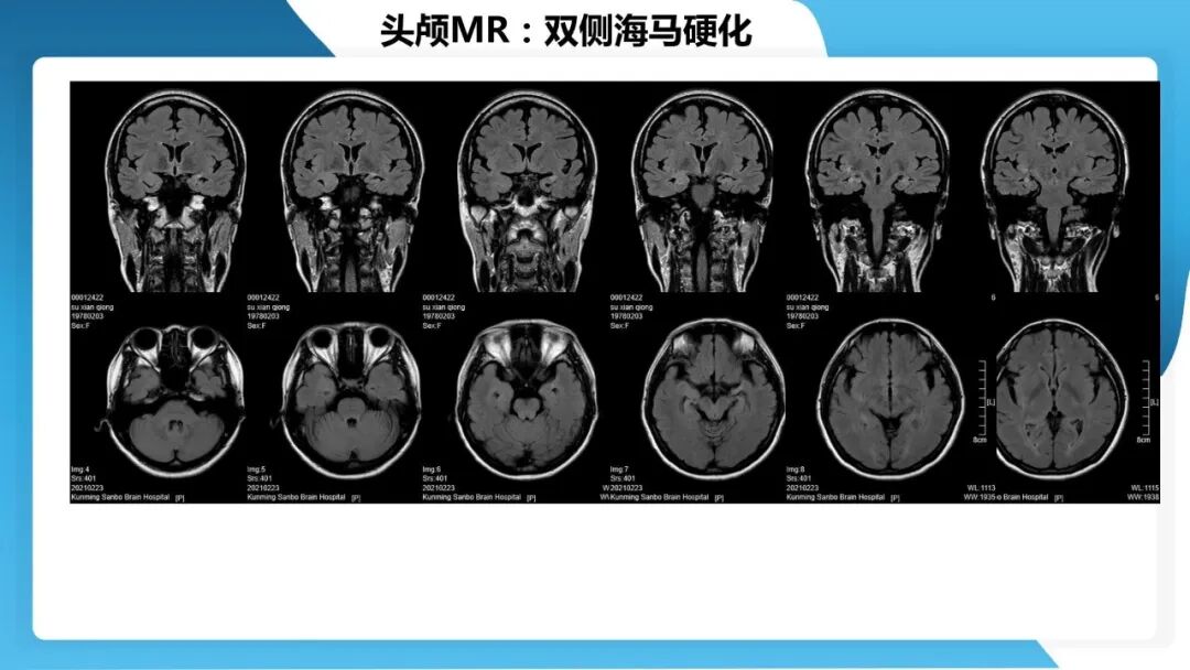 《「痫停」信步》癫痫治疗病例荟萃第五十三期：立体定向脑电图引导射频热凝毁损（SEEG-RFTC）治疗难治性癫痫 1 例