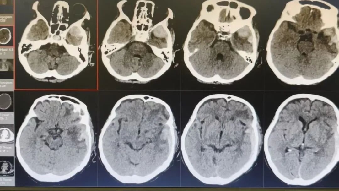 89 岁熊猫血老人脑内大面积出血，竟凭「保守治疗」闯过生死关