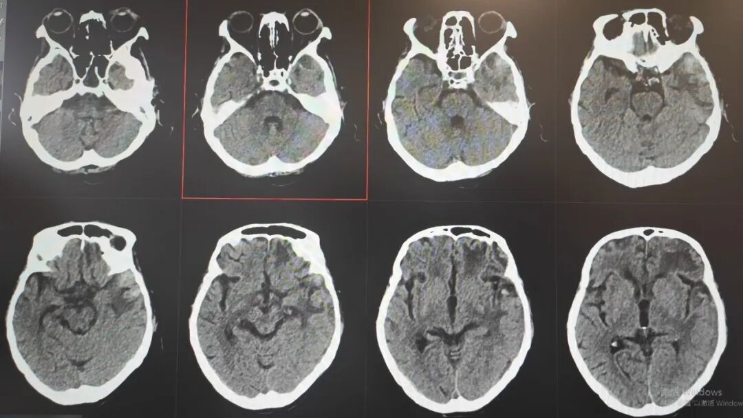 89 岁熊猫血老人脑内大面积出血，竟凭「保守治疗」闯过生死关