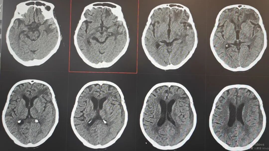 89 岁熊猫血老人脑内大面积出血，竟凭「保守治疗」闯过生死关