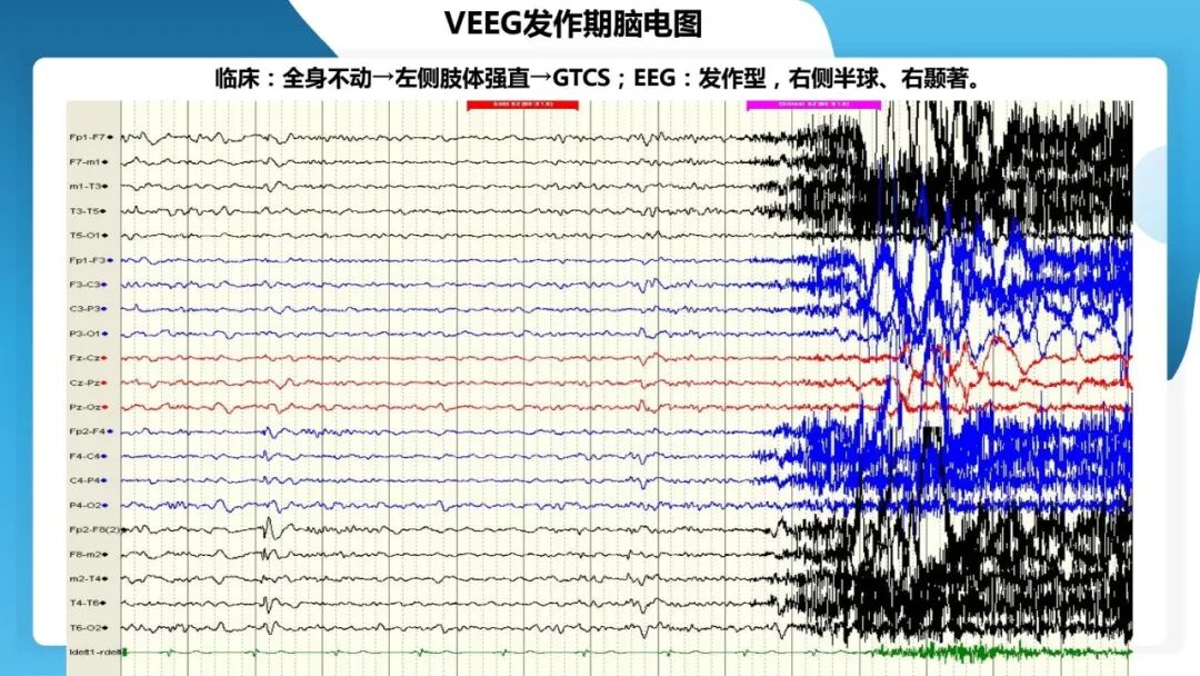 《「痫停」信步》癫痫治疗病例荟萃第五十三期：立体定向脑电图引导射频热凝毁损（SEEG-RFTC）治疗难治性癫痫 1 例