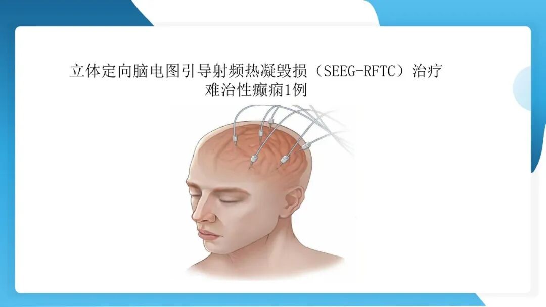 《「痫停」信步》癫痫治疗病例荟萃第五十三期：立体定向脑电图引导射频热凝毁损（SEEG-RFTC）治疗难治性癫痫 1 例