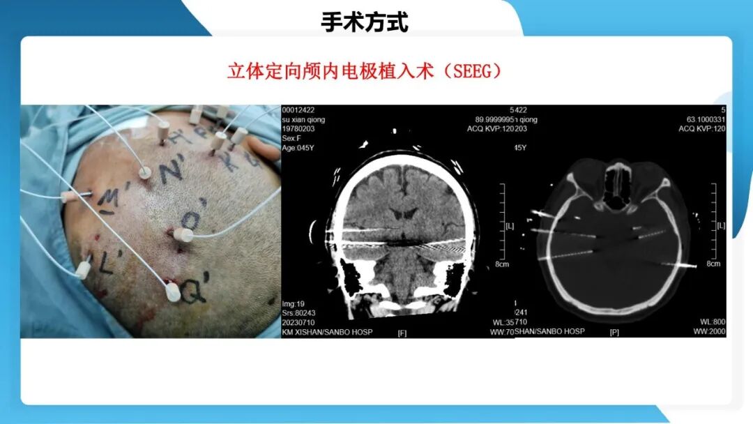 《「痫停」信步》癫痫治疗病例荟萃第五十三期：立体定向脑电图引导射频热凝毁损（SEEG-RFTC）治疗难治性癫痫 1 例