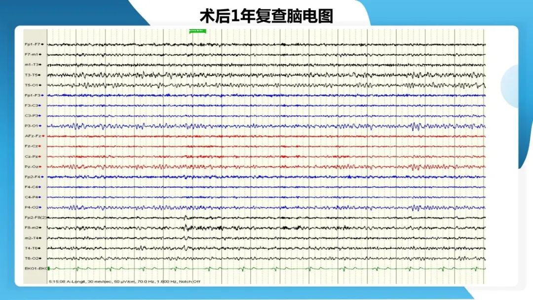 《「痫停」信步》癫痫治疗病例荟萃第五十三期：立体定向脑电图引导射频热凝毁损（SEEG-RFTC）治疗难治性癫痫 1 例