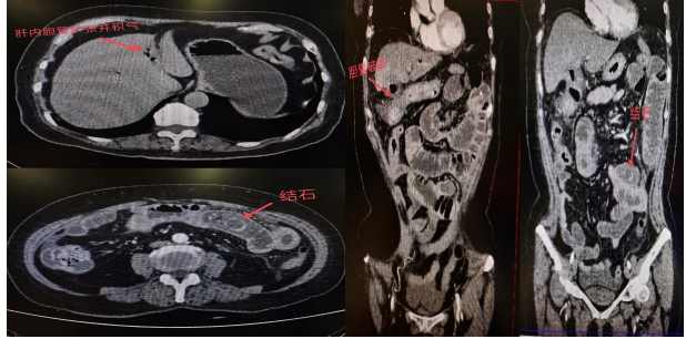 胆囊结石忍了又忍，这次撑破胆囊掉进小肠卡死