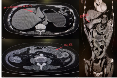 胆囊结石忍了又忍，这次撑破胆囊掉进小肠卡死