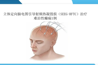 《「痫停」信步》癫痫治疗病例荟萃第五十三期：立体定向脑电图引导射频热凝毁损（SEEG-RFTC）治疗难治性癫痫 1 例