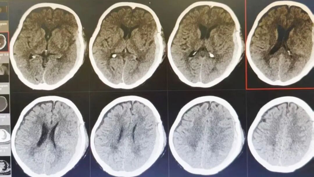 89 岁熊猫血老人脑内大面积出血，竟凭「保守治疗」闯过生死关