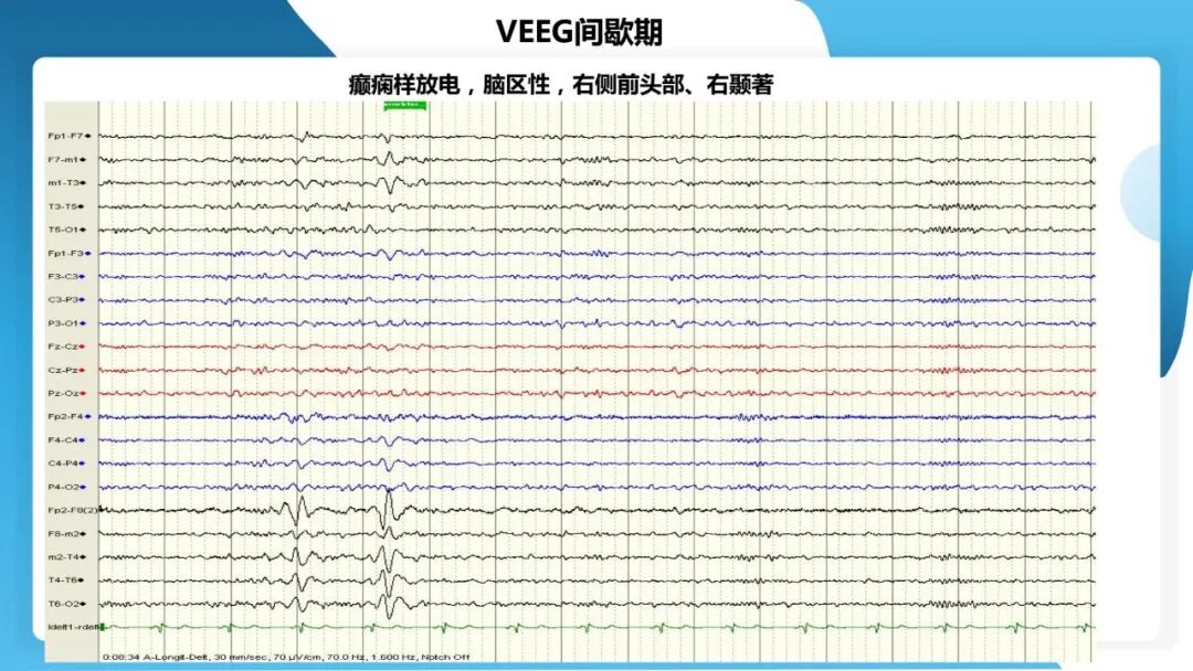《「痫停」信步》癫痫治疗病例荟萃第五十三期：立体定向脑电图引导射频热凝毁损（SEEG-RFTC）治疗难治性癫痫 1 例