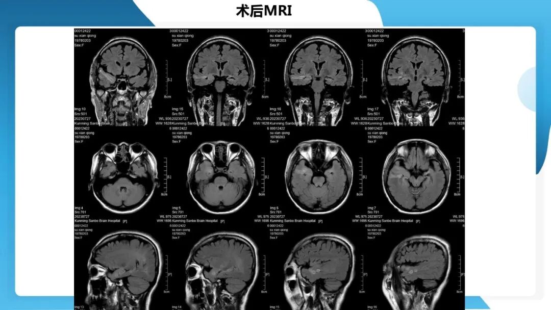 《「痫停」信步》癫痫治疗病例荟萃第五十三期：立体定向脑电图引导射频热凝毁损（SEEG-RFTC）治疗难治性癫痫 1 例