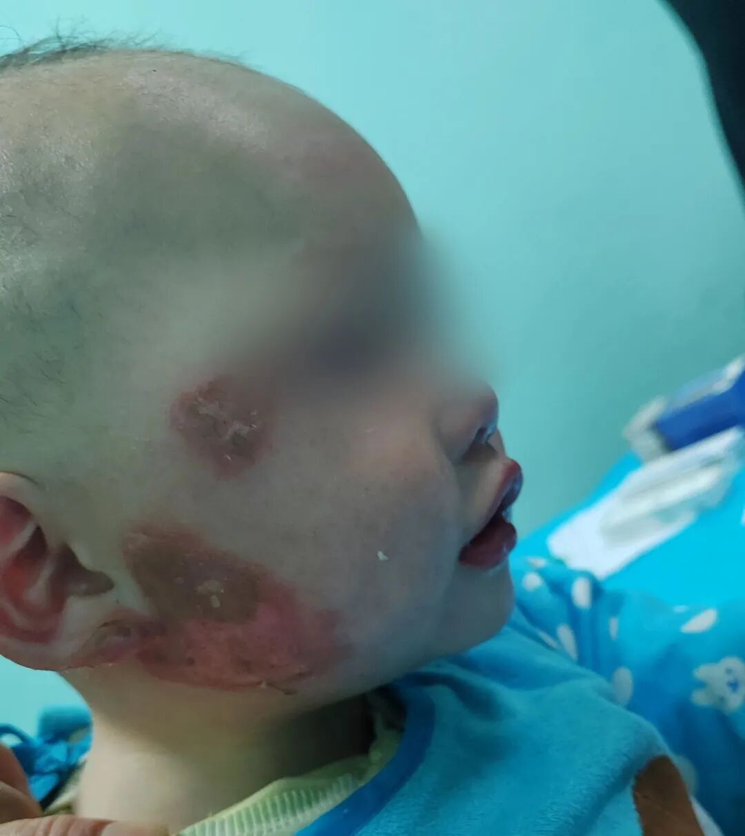 1 岁男婴翻入火盆致面部烧伤，家长抹牙膏 「急救」 反添大麻烦！