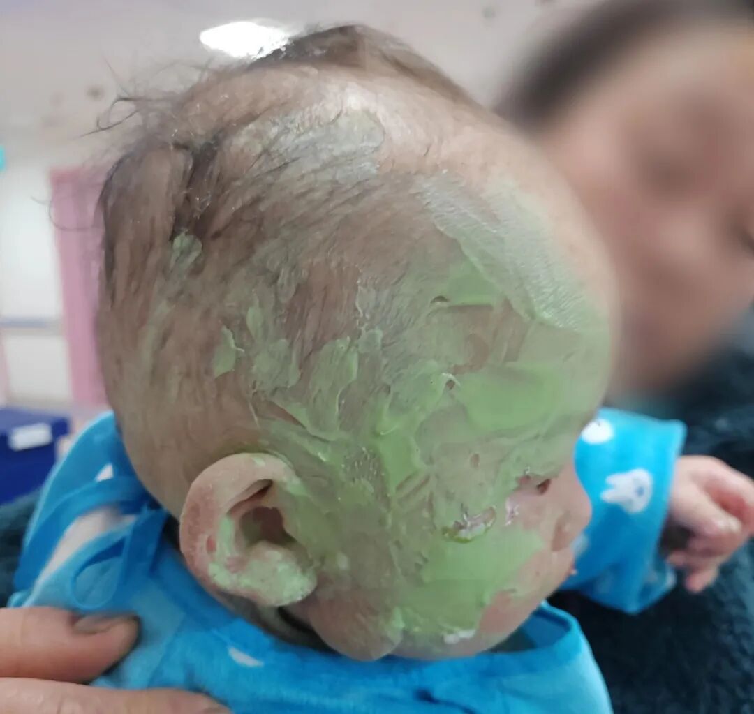 1 岁男婴翻入火盆致面部烧伤，家长抹牙膏 「急救」 反添大麻烦！