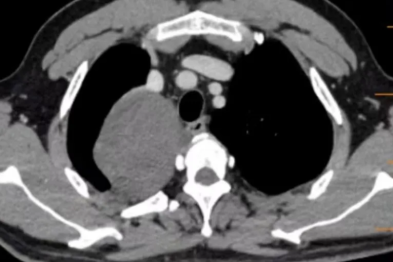9 cm 胸腔巨瘤「盘踞」体内，微创技术如何巧妙化解危机？
