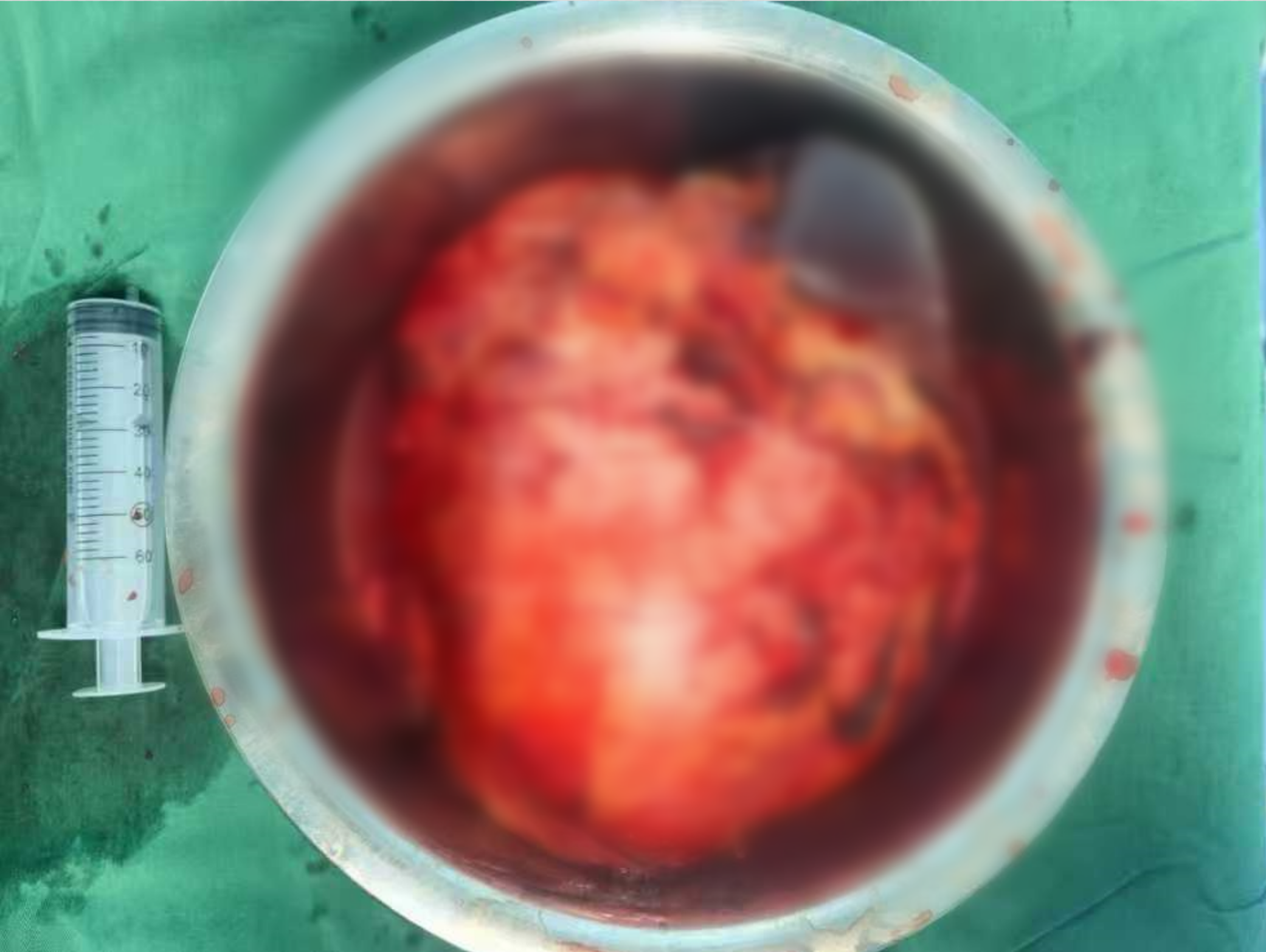 本想「割痔疮」，却意外发现肾上长个「西瓜大」肿瘤