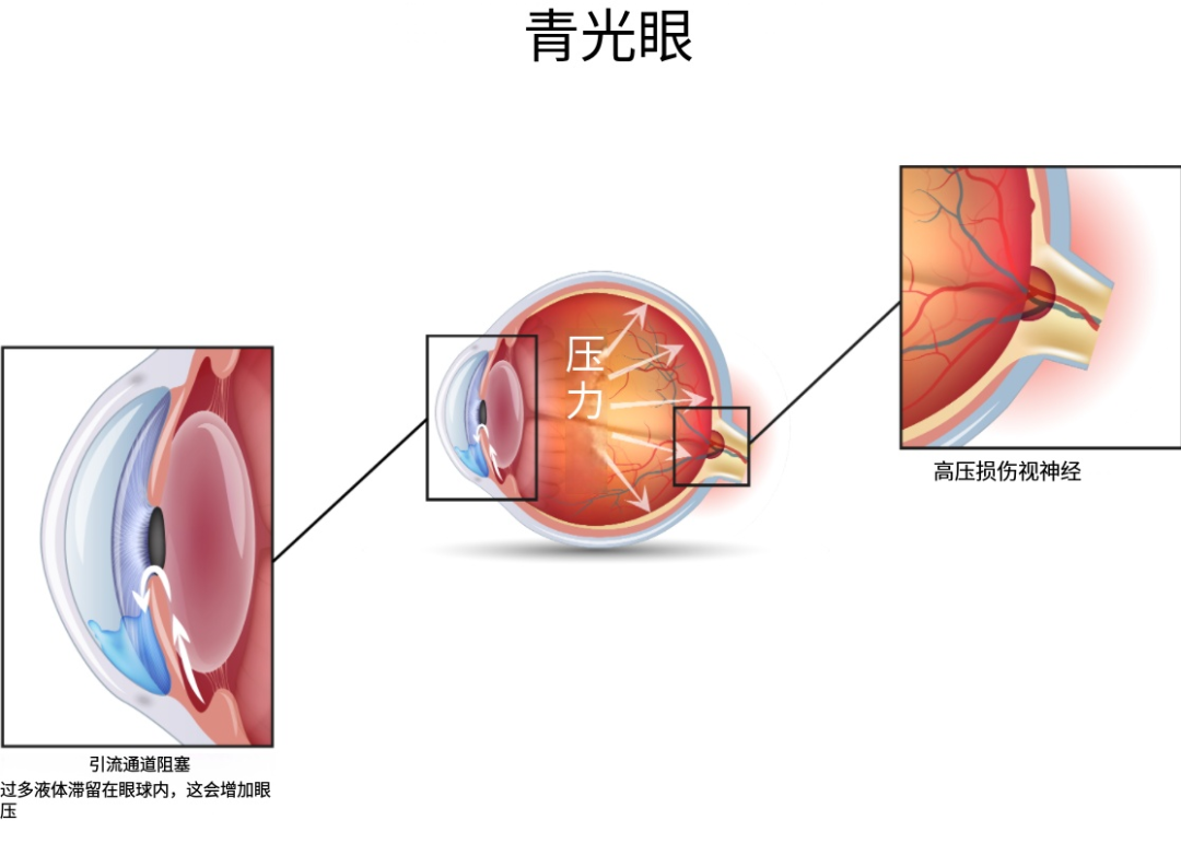 不挑年龄、致盲不可逆！这个「视力小偷」需警惕→