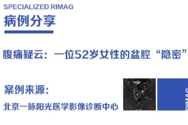 典型病例  |  腹痛疑云：一位 52 岁女性的盆腔「隐密」与影像探案