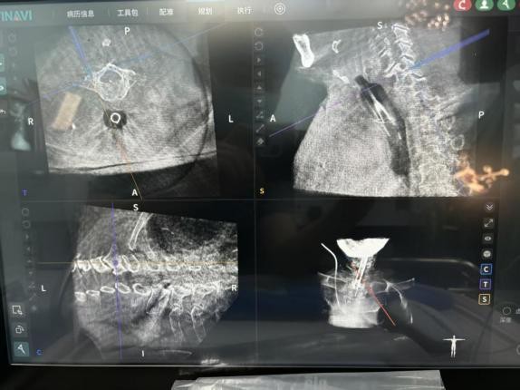 机器人精准 「拆弹」！郑州市中心医院脊柱外科攻克高龄复杂颈椎病手术难题