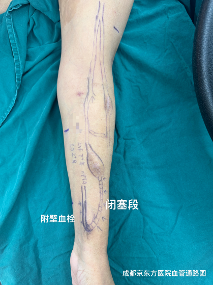 8 年透析「生命线」濒临枯竭，PTA+重建「双剑合璧」，成都京东方医院攻克高难度透析通路难题