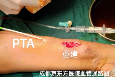 8 年透析「生命线」濒临枯竭，PTA+重建「双剑合璧」，成都京东方医院攻克高难度透析通路难题