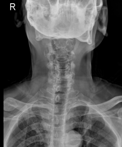 机器人精准 「拆弹」！郑州市中心医院脊柱外科攻克高龄复杂颈椎病手术难题