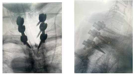 机器人精准 「拆弹」！郑州市中心医院脊柱外科攻克高龄复杂颈椎病手术难题