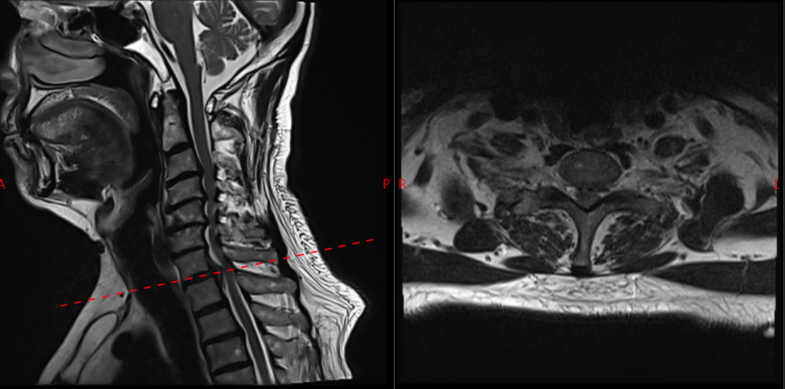 机器人精准 「拆弹」！郑州市中心医院脊柱外科攻克高龄复杂颈椎病手术难题