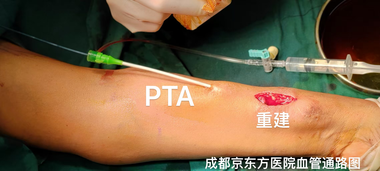 8 年透析「生命线」濒临枯竭，PTA+重建「双剑合璧」，成都京东方医院攻克高难度透析通路难题