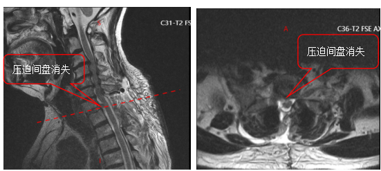 机器人精准 「拆弹」！郑州市中心医院脊柱外科攻克高龄复杂颈椎病手术难题