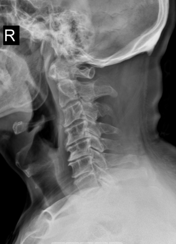机器人精准 「拆弹」！郑州市中心医院脊柱外科攻克高龄复杂颈椎病手术难题