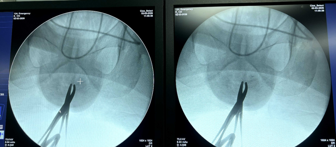 坐立难安半年，反复就医无果，医生一查：体内有 7 枚钉子