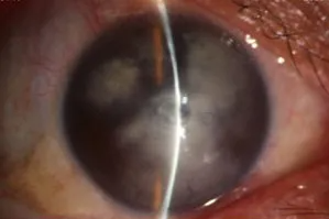 辽宁爱尔陈铁红主任为 61 岁角膜白斑患者终结三年求医路