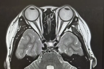 月经紊乱、面容改变、手脚变大……这些症状可能指向同一个脑部疾病