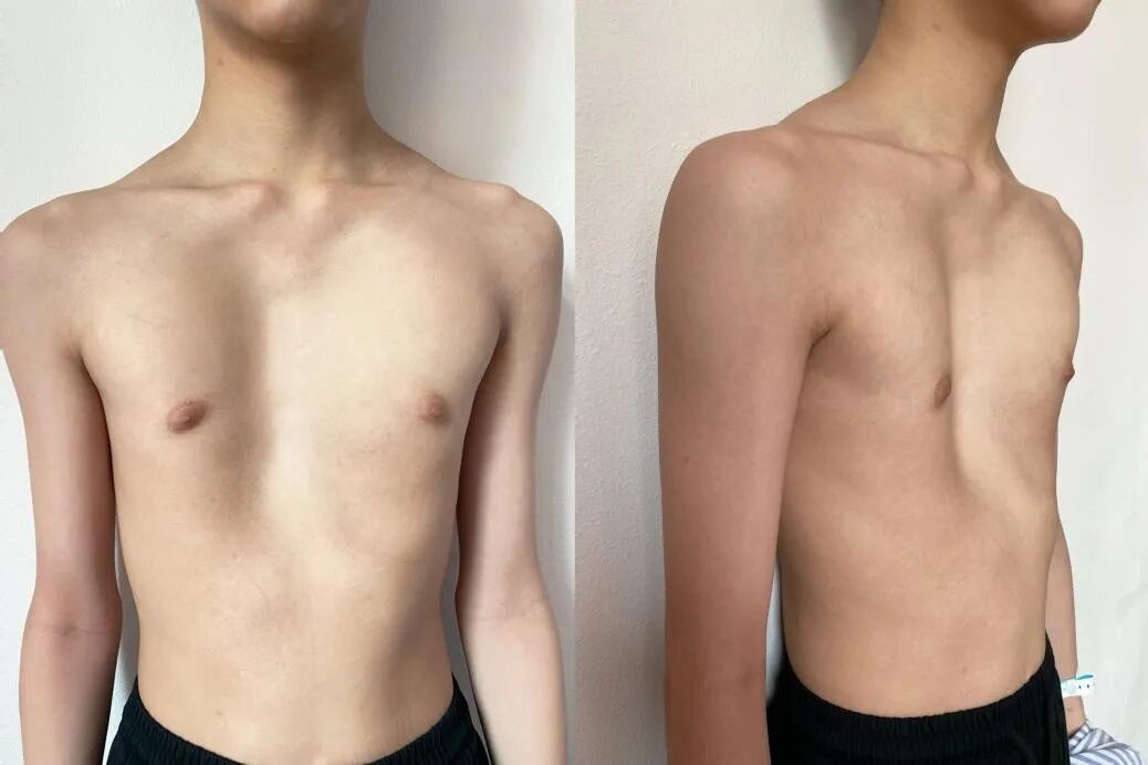 重度漏斗胸少年获精准矫治，漳州第三医院胸外科团队助其「挺起胸膛」