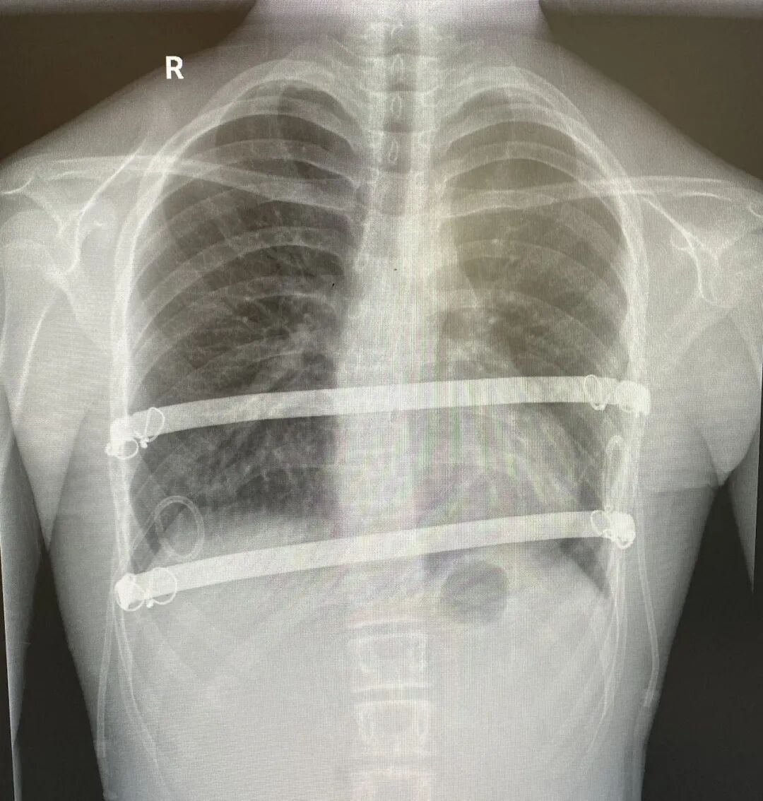 重度漏斗胸少年获精准矫治，漳州第三医院胸外科团队助其「挺起胸膛」