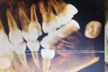 深埋牙槽的牙齿，如何微创「拆弹」？