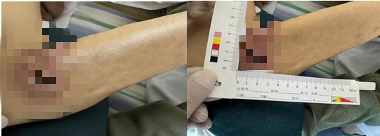 多重困境下的创面守护:燕达老年医学科 6 周专业护航,助力高龄患者创面恢复