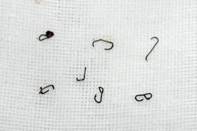 坐立难安半年，反复就医无果，医生一查：体内有 7 枚钉子