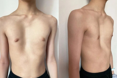 重度漏斗胸少年获精准矫治，漳州第三医院胸外科团队助其「挺起胸膛」