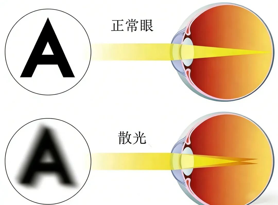 散光≠近视！别再混淆了
